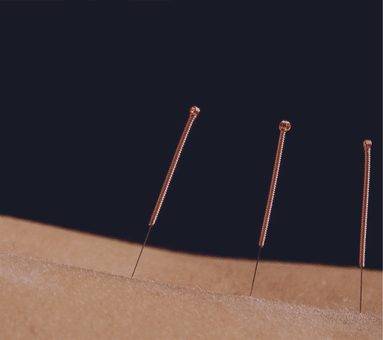 Acupuncture-needles-in-human-body